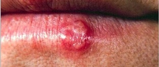 Герпес на губах (простой герпес). Информация для пациентов