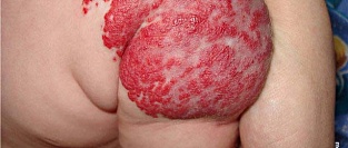 Гемангиома у детей. Клиника, диагностика, подход к лечению.