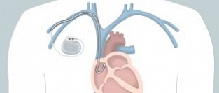 Электрокардиостимулятор. Просто о сложном