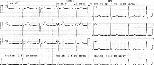 Синусовый ритм и синусовая аритмия