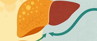 MASLD/MASH: новые возможности фармакотерапии