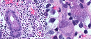 Рекомендации по микроскопическому колиту 2016