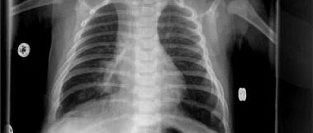 Диагностика вирусной пневмонии