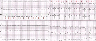 Совместные рекомендации ESC/EACTS по фибрилляции предсердий 2016