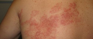 Опоясывающий лишай. В поисках причин роста заболеваемости