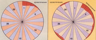 Сотрясение мозга. Влияние на менструальный цикл