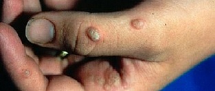 Бородавки. Описание элементов.