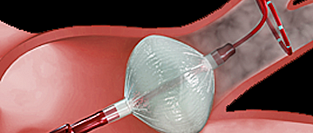 Фибрилляция предсердий. Экономические аспекты аблации для пациентов