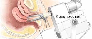 Кольпоскопия. Информация для пациентов.