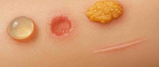 Вторичные элементы кожной сыпи: корка, чешуйка, эрозия и другие