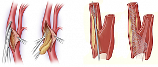 Бессимптомные стенозы сонных артерий. Каротидная эндартерэктомия или стентирование