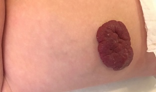 Гемангиома