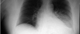 Вирусная пневмония. Симптомы и особенности клинической картины