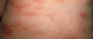 Токсическая эритема новорожденных