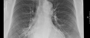 Подход к ребенку со свистящими хрипами