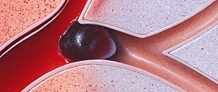 Тромболизис у пациентов после хирургических вмешательств