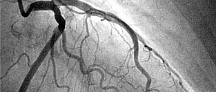 Коронарография в вопросах и ответах. Информация для пациентов