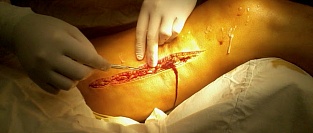 Некротизирующий фасциит. Фасциотомия