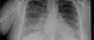 Причины пневмонии у детей