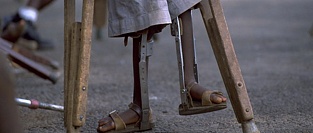 Полиомиелит. Симптомы, диагностика, лечение, профилактика.