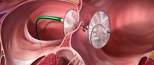 Криптогенный инсульт. Рекомендации AAN 2016 