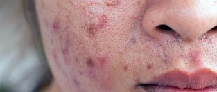 FDA одобряет новый крем против угревой сыпи