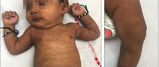 Диффузная гиперпигментация при лихорадке чикунгунья