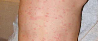 Внезапная экзантема (детская розеола). Описание элементов сыпи.