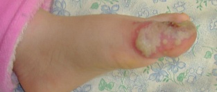 Герпетический панариций. Шестой день болезни