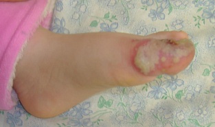 Герпетический панариций. Шестой день болезни