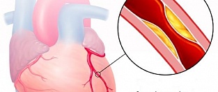 Ишемическая болезнь сердца. Нет ничего стабильного
