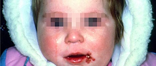 Герпес губной ("простуда" на губах). Описание элементов.