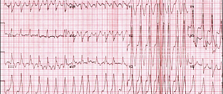 Фибрилляция предсердий. Влияние агрессивной антигипертензивной терапии на риск рецидивов после аблации