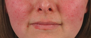 Системная красная волчанка (СКВ) и беременность. Результаты проспективного исследования