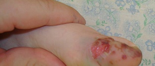 Герпетический панариций. Case report.