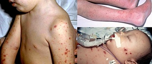 Пневмококковая инфекция