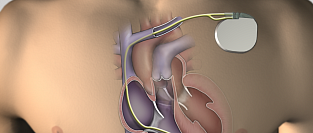 Имплантации электрокардиостимуляторов и других устройств и антикоагуляция