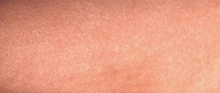 Англия и Уэльс. Причины роста заболеваемости скарлатиной