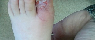 Герпетический панариций у ребенка