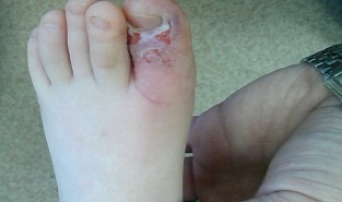 Герпетический панариций у ребенка