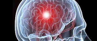 Ишемический инсульт. Двойная или тройная антиагрегантная терапия?