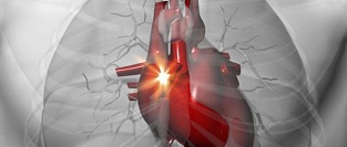 Учащенное сердцебиение (тахикардия). Информация для пациентов