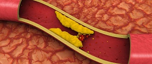 В поисках целевого уровня ЛПНП на фоне лечения статинами