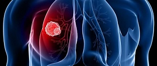 Рак легких. О влиянии скрининга на смертность