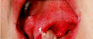 Глобальная эпидемиология дифтерии 2000–2017 гг.