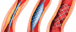 Стентирование сосудов сердца