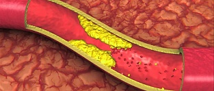Холестерин. О нормах и интерпретации результатов
