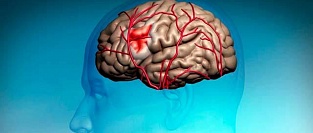 Инсульт и способность к вождению автомобиля