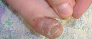Герпетический панариций. Пятый день болезни