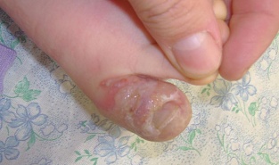 Герпетический панариций. Пятый день болезни